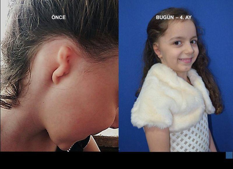 Gaziantepli küçük kıza kaburgasından kulak yapıldı