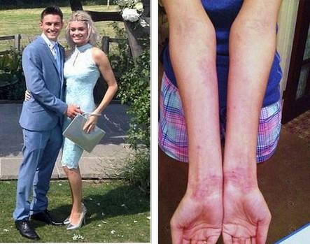 Egzemalarıyla dalga geçilen kız güzellik kraliçesi oldu