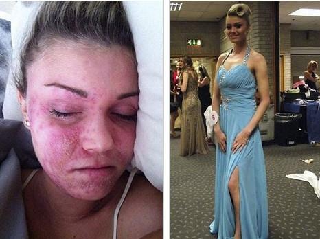 Egzemalarıyla dalga geçilen kız güzellik kraliçesi oldu