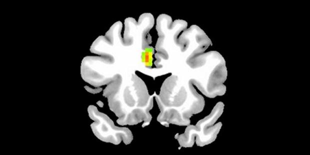 Aşık insanların beyin MR'ı çekildi