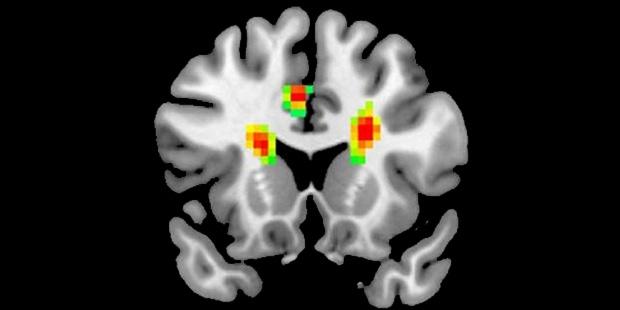 Aşık insanların beyin MR'ı çekildi