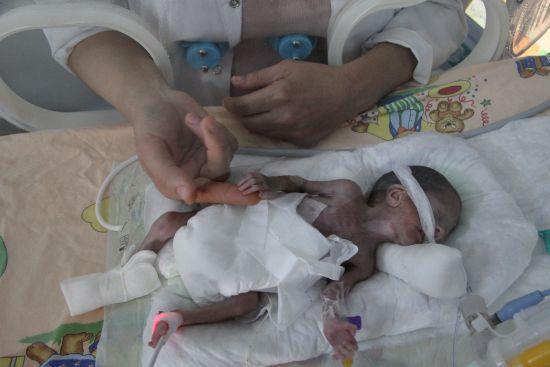 500 gram doğan parmak bebek hayata tutundu