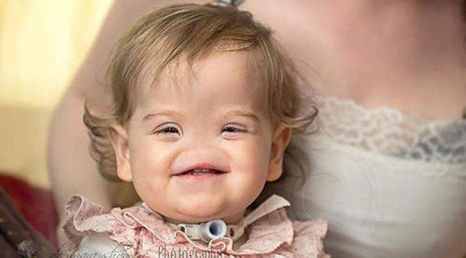 İrlanda'da burunsuz doğan bebeğe yeni burun yapılacak