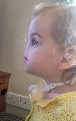 İrlanda'da burunsuz doğan bebeğe yeni burun yapılacak