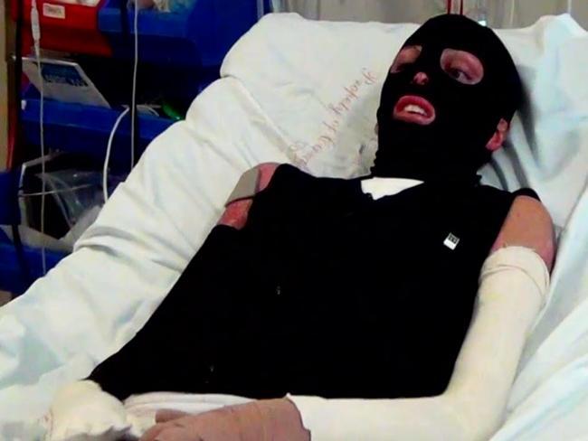 Maratonda vücudu yanan sporcu sevgilisi ile nişanlandı