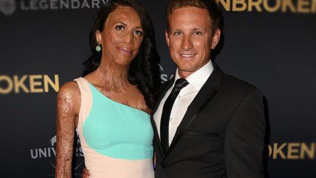 Maratonda vücudu yanan sporcu sevgilisi ile nişanlandı