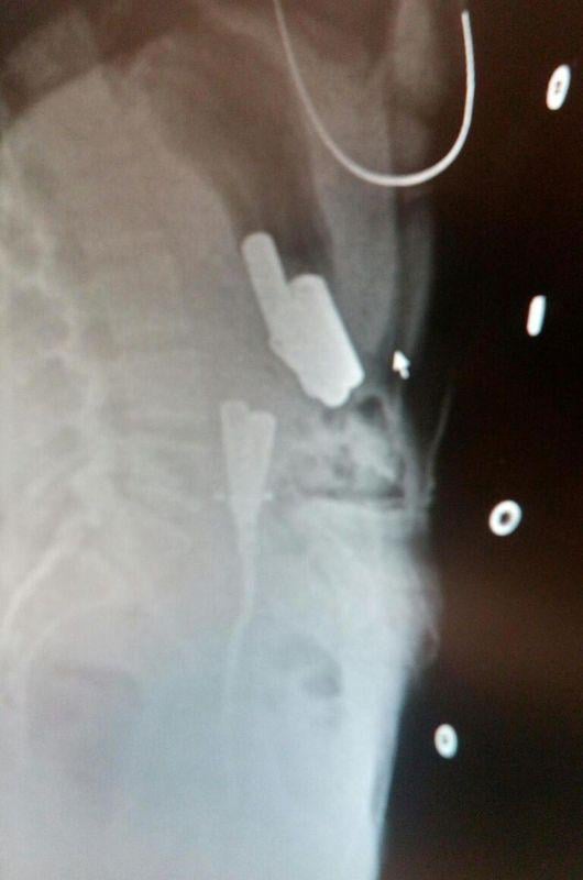 Düzce'de genç kız 8 pil yuttu