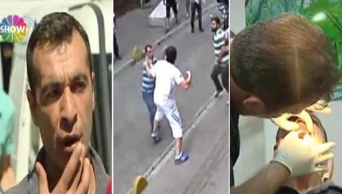 İrlandalı turistten yumruk yiyen esnaf dişlerini yaptırdı