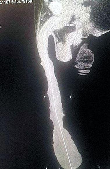 Dünyanın en uzun penisli adamı isyan etti