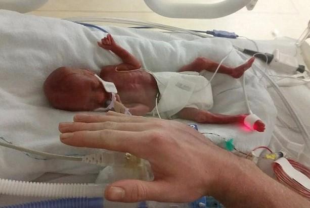 23 haftalık doğan bebek hayata tutundu