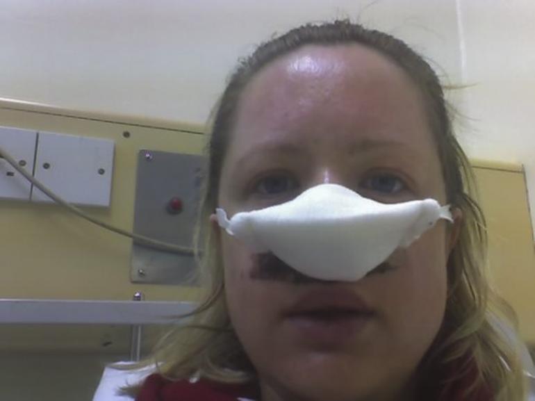 Hapşırdı burun kemiği elinde kaldı