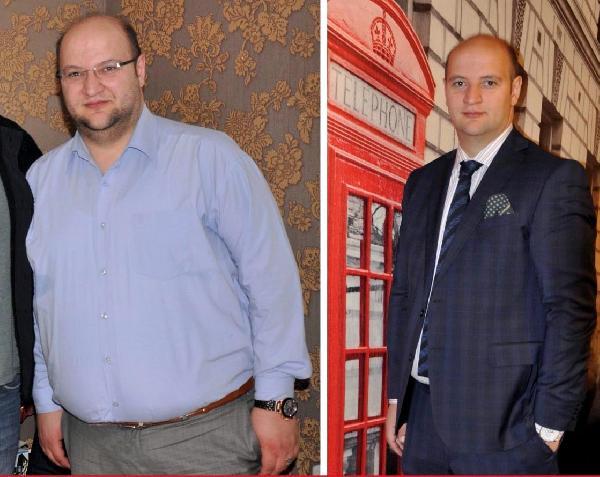 Tüp mide ameliyatıyla 48 kilo verdi