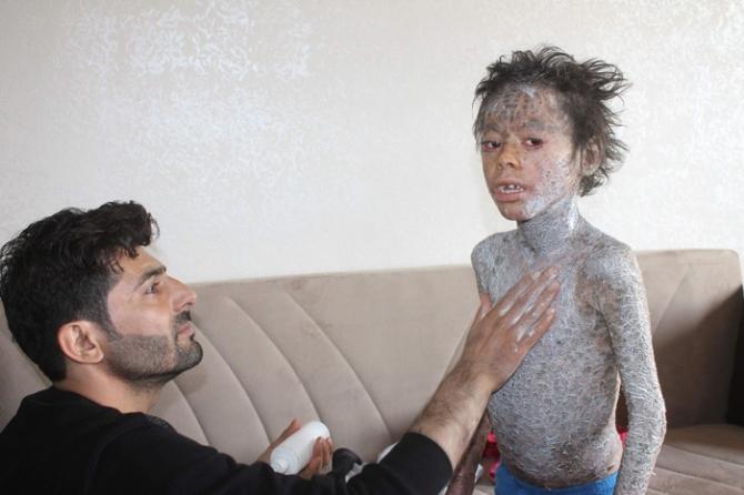 Balık hastalığına yakalanan Melih yardım bekliyor