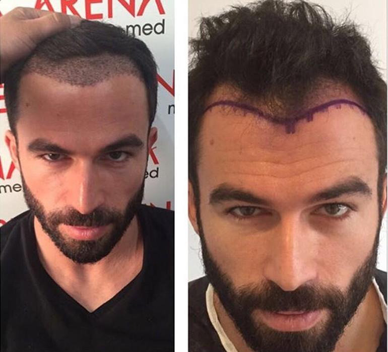 Turabi Çamkıran saç ektirdi