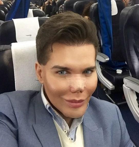 Barbie adamın estetik yüzünden burnu çürüdü