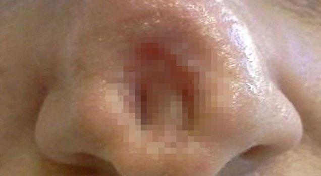 Sahte kanser ilacı burnunda delik açtı