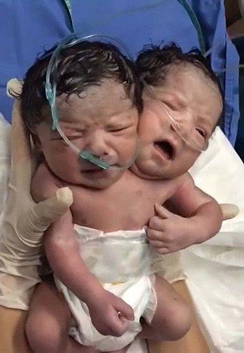 Meksika'da iki başlı bebek doğdu