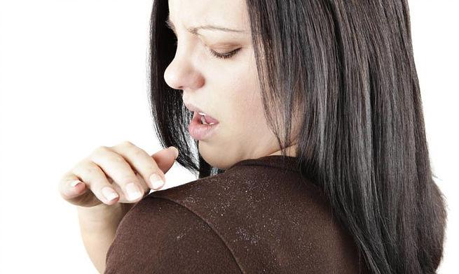 Kepeğe karşı bitkisel çözümler