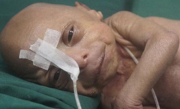 Bangladeş'te yaşlı bebek dünyaya geldi