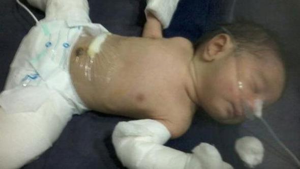 Hindistan'da bir bebek hamile doğdu