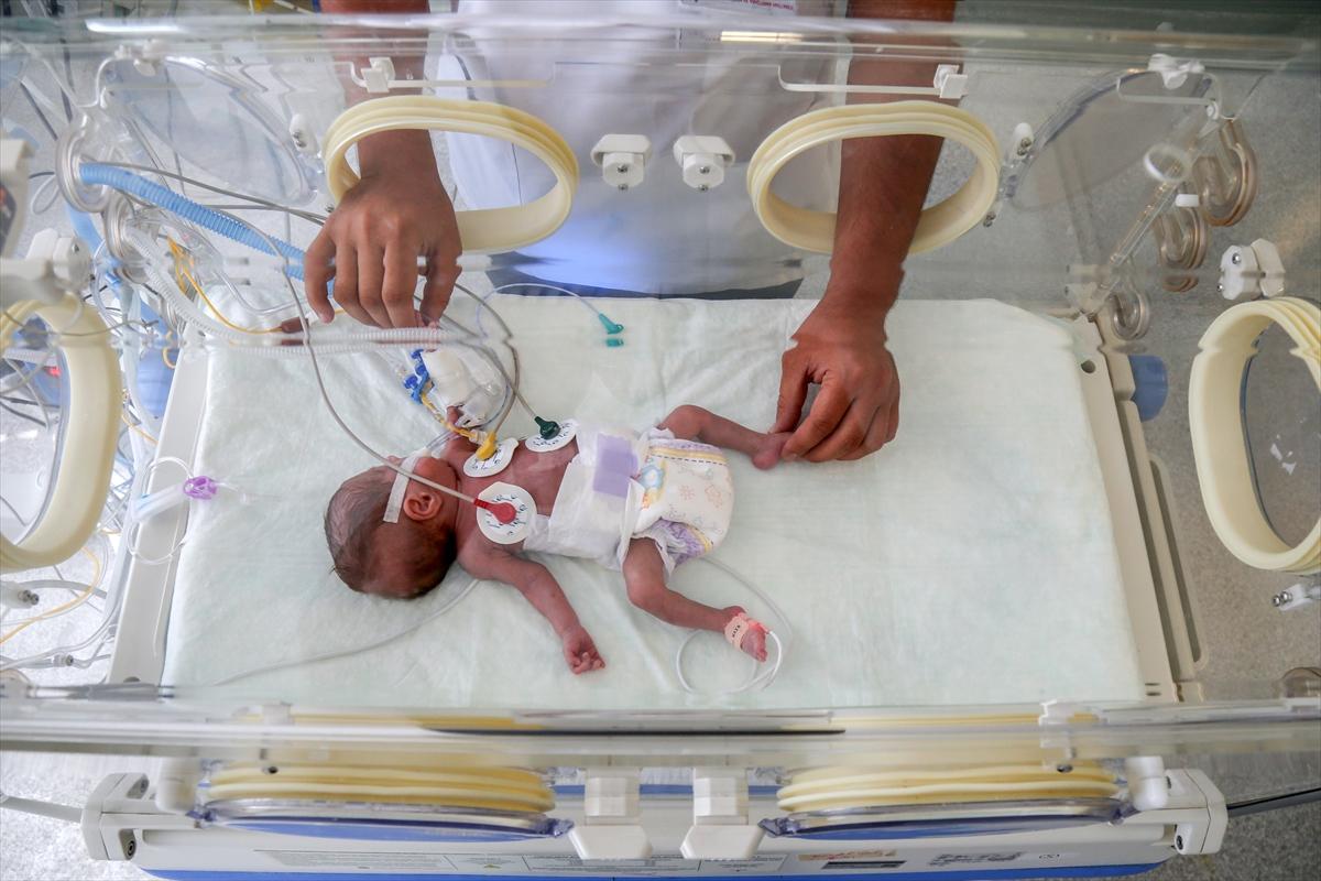 Mucize bebek ameliyatla yaşama tutundu