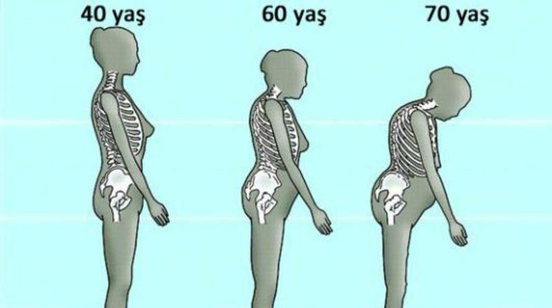 Kemik erimesine ne iyi gelir