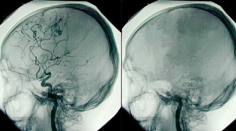 Beyin ölümü nedir