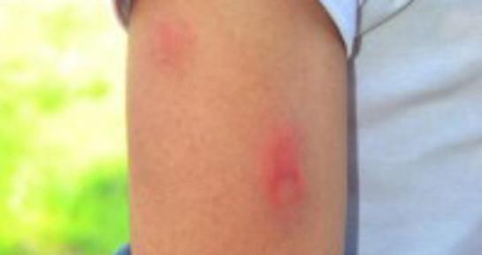 Beriberi hastalığı nedir