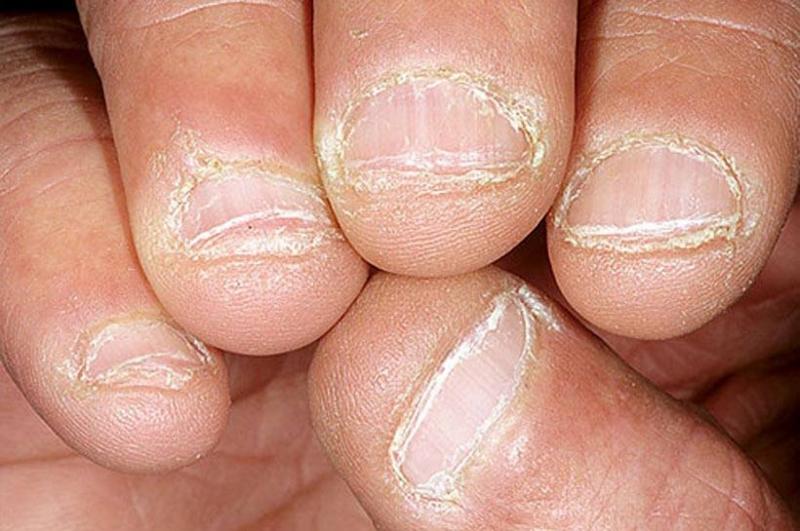 Tırnak yeme alışkanlığı nasıl bırakılır