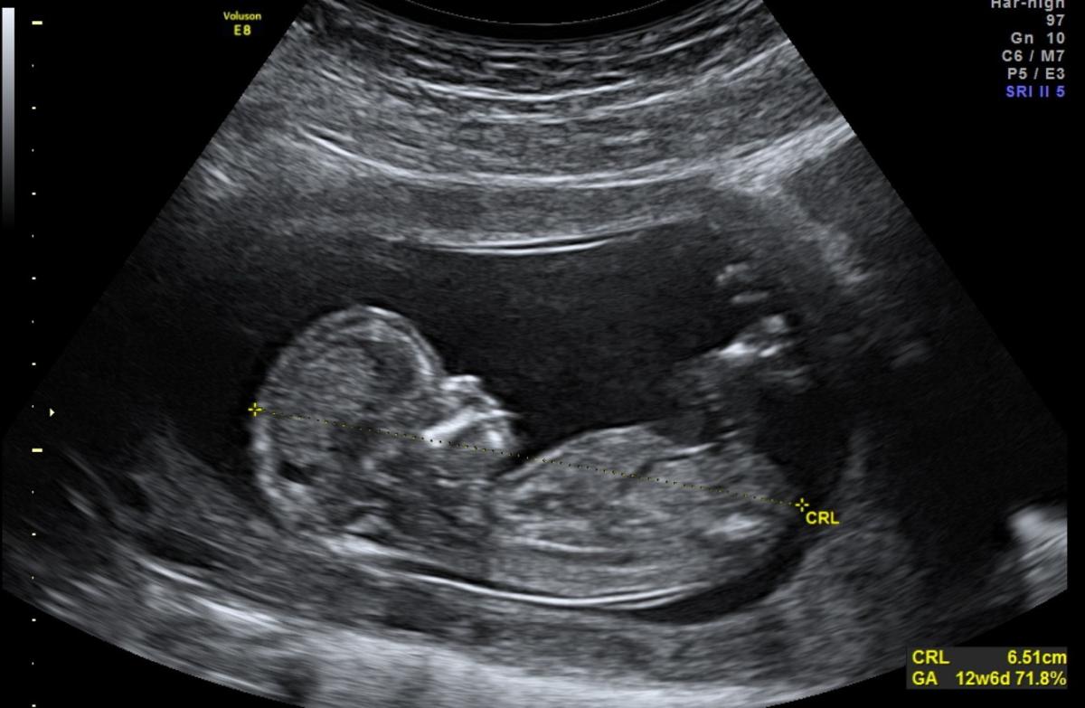 Gebelik takibi hayati önem taşıyor