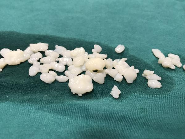 Dizlerinden 967 adet eklem faresi çıktı