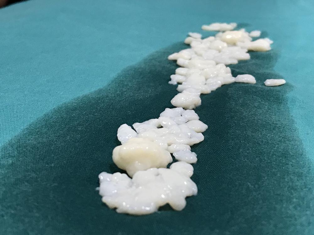 Dizlerinden 967 adet eklem faresi çıktı