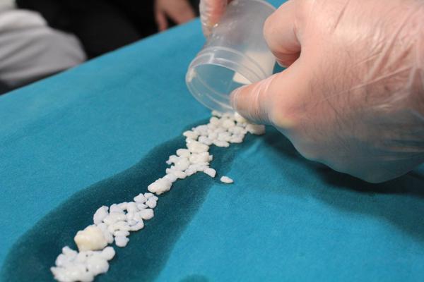 Dizlerinden 967 adet eklem faresi çıktı