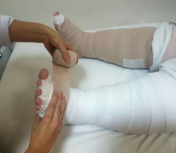 Lenfödem Hastalığı nedir