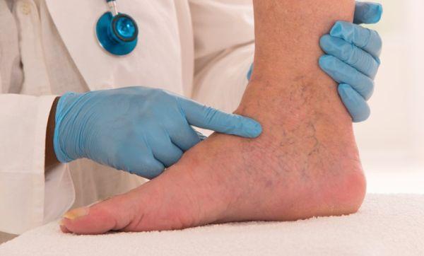 Lenfödem Hastalığı nedir