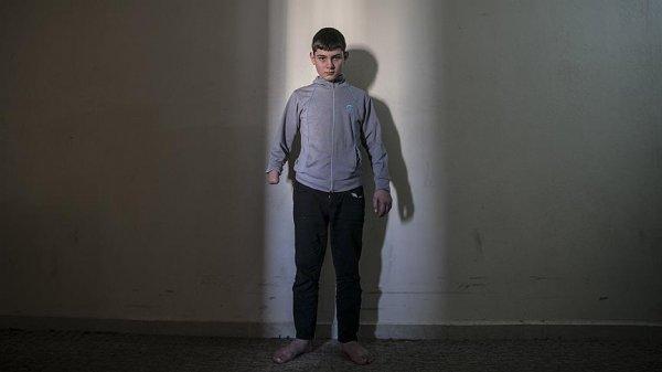 Suriyeli Maret'in hayali protez bir el