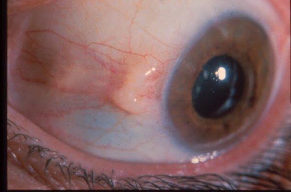 Gözde et yürümesi nedir