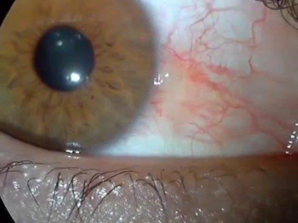 Gözde et yürümesi nedir