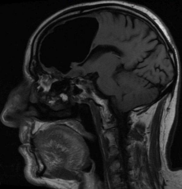 Hastaneye gitti beyninin yarısının olmadığını öğrendi