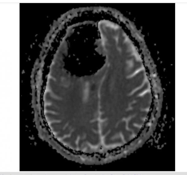 Hastaneye gitti beyninin yarısının olmadığını öğrendi