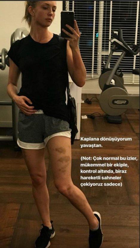 Yasemin Allen'ın bacakları mosmor