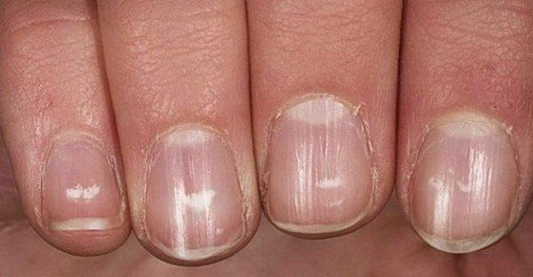 Tırnaklardaki beyaz lekeler bazı hastalıkların habercisi