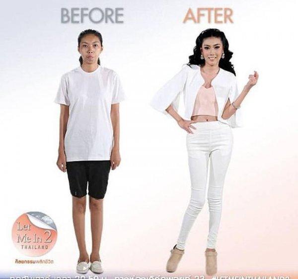 Taylandlı kadının ameliyat sonrası muhteşem değişimi