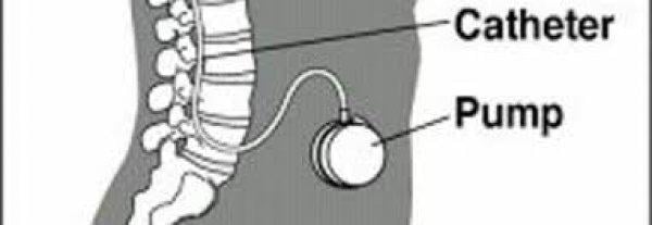 Baklofen pompası nedir