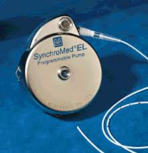 Baklofen pompası nedir