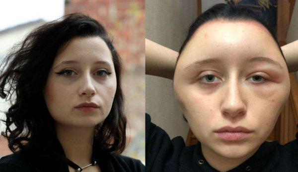 Saç boyasına alerjisi olan kadın yaşamını yitiriyordu