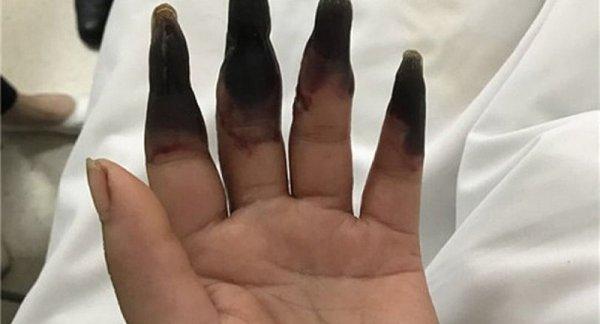 Elindeki kesik nedeniyle 8 parmağını birden kaybediyordu