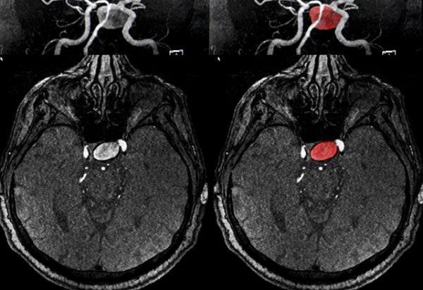 Beyin anjiyosu nedir