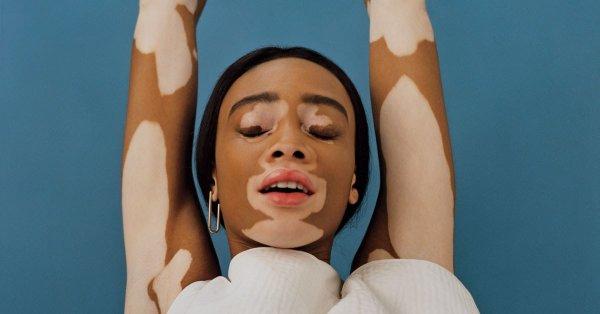 Vitiligo nedir