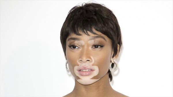 Vitiligo nedir